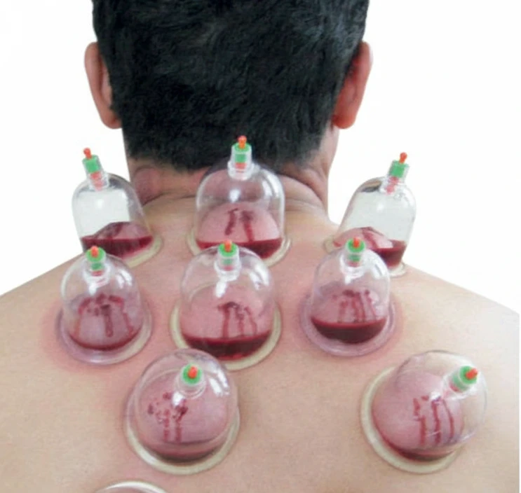 Hijama (Cupping Therapy) Set â€“ 10 Pieces